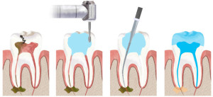rootcanal3